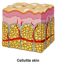 Tratamiento de celulitis